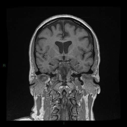 Cerebellar abscess (Radiopaedia 78135-90678 Coronal T1 C+ 73).jpg