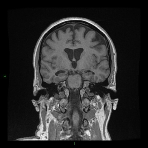 Cerebellar abscess (Radiopaedia 78135-90678 Coronal T1 C+ 80).jpg