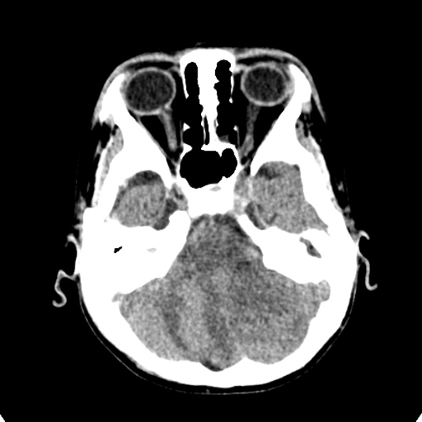 Cerebellar abscess secondary to mastoiditis (Radiopaedia 26284-26412 Axial non-contrast 36).jpg