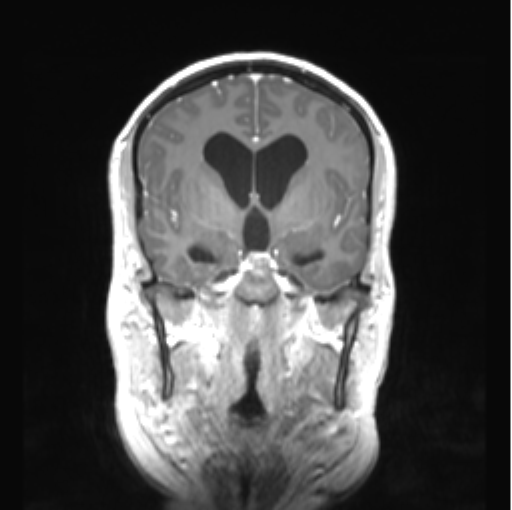Cerebellar ependymoma complicated by post-operative subdural hematoma (Radiopaedia 83322-97736 Coronal T1 C+ 24).png