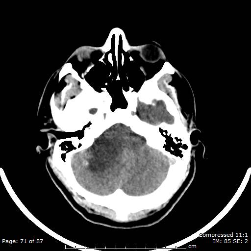 Cerebellar hemangioblastoma (Radiopaedia 52360-58258 Axial non-contrast 71).jpg