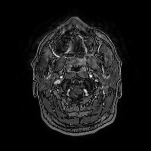 Cerebellar hemangioblastoma (Radiopaedia 88055-104622 Axial T1 C+ 23).jpg