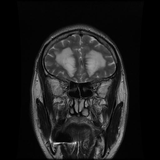 File:Cerebellar hemangioblastoma (Radiopaedia 88055-104622 Coronal T2 1).jpg