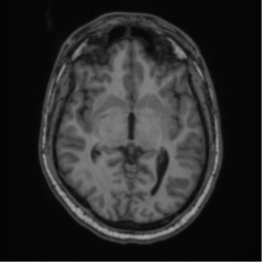 File:Cerebellar hemangioblastomas and pituitary adenoma (Radiopaedia 85490-101176 Axial T1 35).png