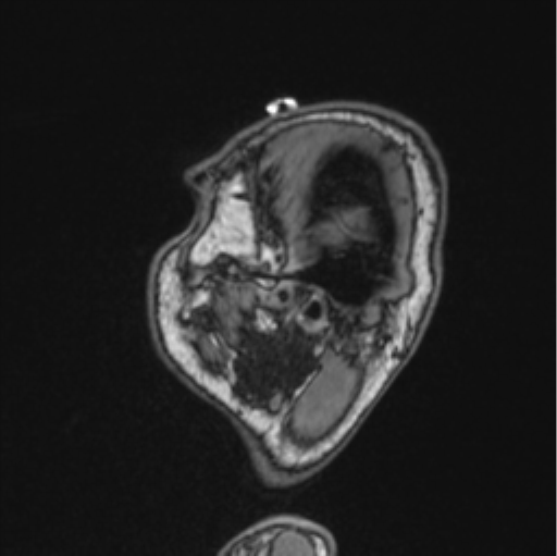 Cerebellar hemangioblastomas and pituitary adenoma (Radiopaedia 85490-101176 Sagittal T1 84).png