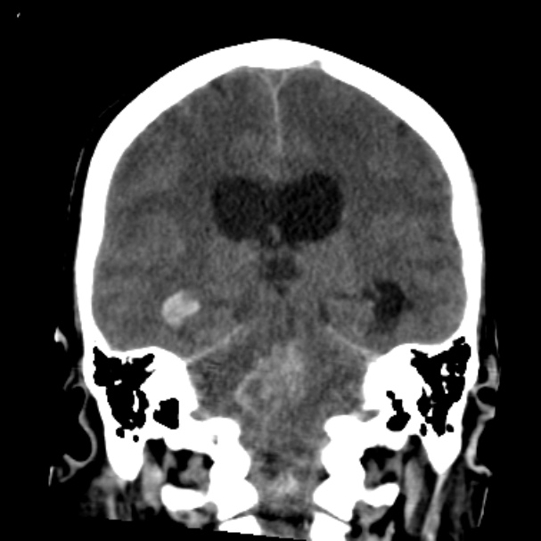 Cerebellar hemorrhage causing obstructive hydrocephalus (Radiopaedia 33989-35207 Coronal non-contrast 33).jpg