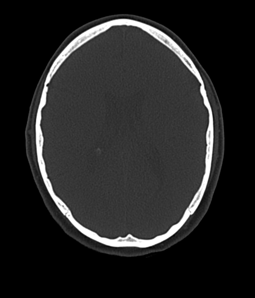 Cerebellar metastases - colorectal adenocarcinoma (Radiopaedia 40947-43652 AX Bone C- 2.0 MPR 37).png