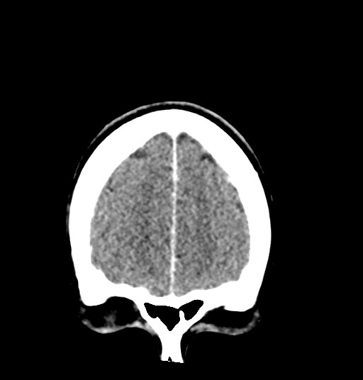 Cerebellar metastases - colorectal adenocarcinoma (Radiopaedia 40947-43652 Coronal C+ 17).png