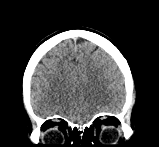 Cerebellar metastases - colorectal adenocarcinoma (Radiopaedia 40947-43652 Coronal non-contrast 27).png