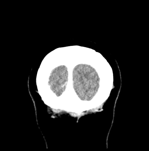 Cerebellar metastasis (Radiopaedia 54578-60812 Coronal C+ 59).png