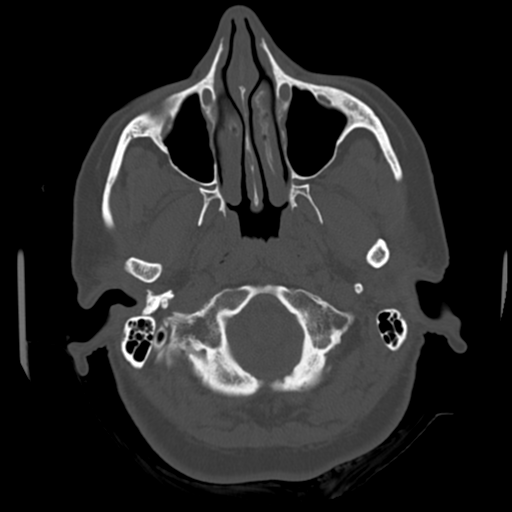Cerebellar metastasis (cystic appearance) (Radiopaedia 41395-44258 Axial bone window 5).png