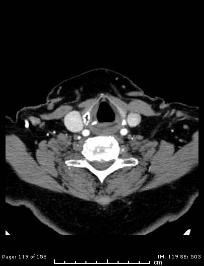 File:Cerebellar strokes due to intracranial giant cell arteritis (Radiopaedia 68799-78510 CT angiogram 119).jpg