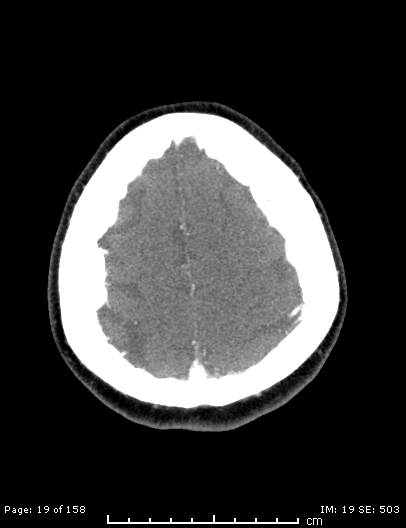 Cerebellar strokes due to intracranial giant cell arteritis (Radiopaedia 68799-78510 CT angiogram 19).jpg