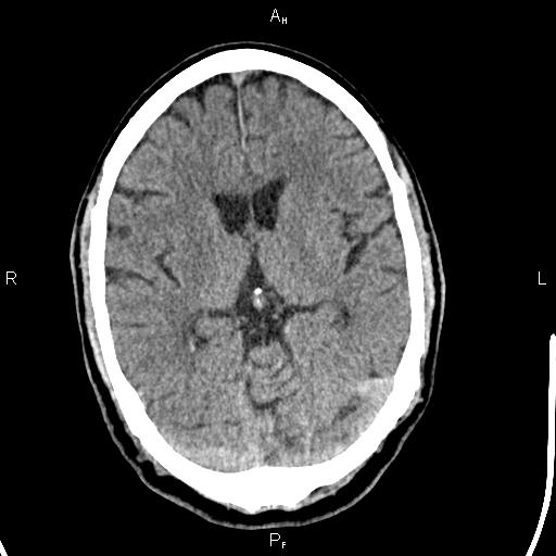 File:Cerebellopontine angle arachnoid cyst (Radiopaedia 85149-100704 Axial With contrast 25).jpg
