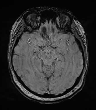 Cerebellopontine angle meningioma (Radiopaedia 48434-53348 Axial SWI 39).png