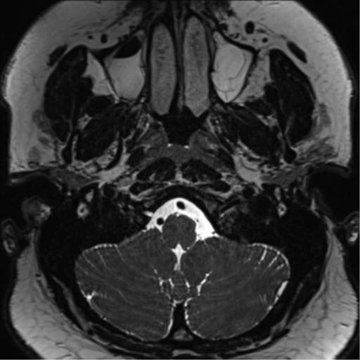 Cerebellopontine angle meningioma (Radiopaedia 48434-53348 Axial T2 Space 19).png