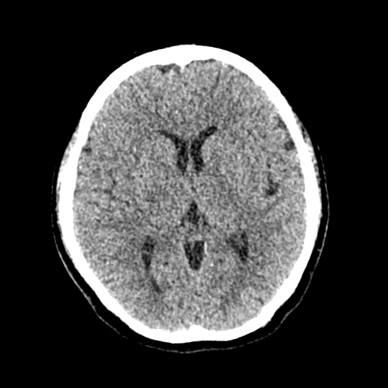 Cerebellopontine angle meningioma (Radiopaedia 53561-59592 Axial non-contrast 35).jpg