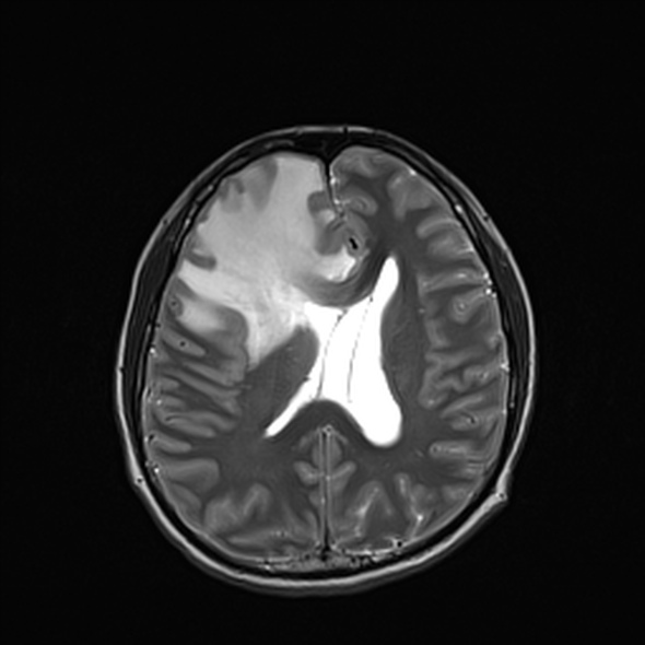 Cerebral abscess (Radiopaedia 24212-24478 Axial T2 38).jpg