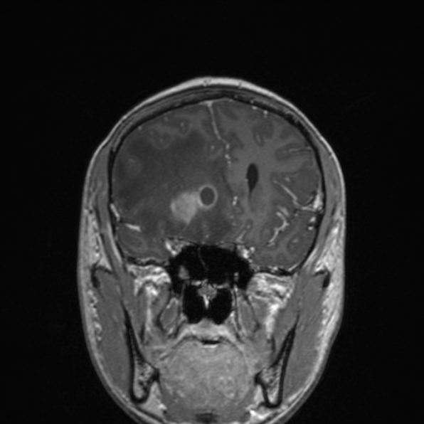 File:Cerebral abscess (Radiopaedia 24212-24478 Coronal T1 C+ 80).jpg