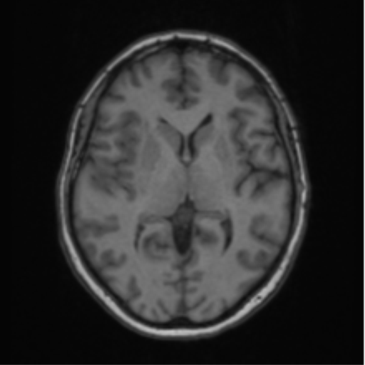 Cerebral abscess from pulmonary arteriovenous malformation (Radiopaedia 86275-102291 Axial T1 39).png