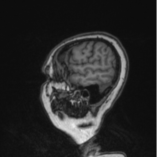 File:Cerebral abscess from pulmonary arteriovenous malformation (Radiopaedia 86275-102291 Sagittal T1 26).png