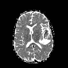 File:Cerebral abscess post cardiac surgery (Radiopaedia 27244-27420 Axial ADC 14).jpg