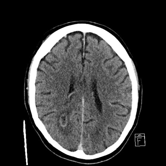 File:Cerebral abscess with ventriculitis (Radiopaedia 78965-91877 A 30).jpg