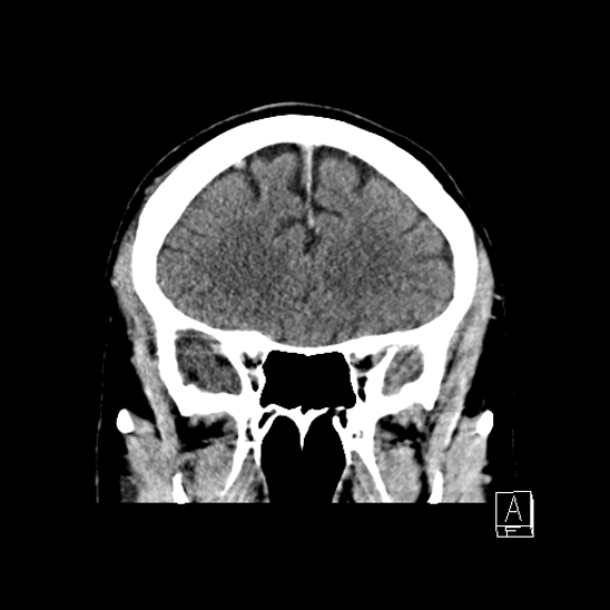 File:Cerebral abscess with ventriculitis (Radiopaedia 78965-91877 B 17).jpg