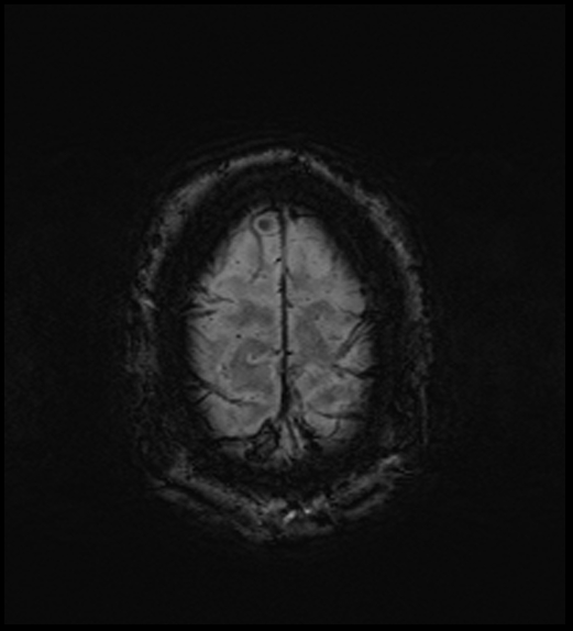 Cerebral abscess with ventriculitis (Radiopaedia 78965-91878 Axial SWI 48).jpg