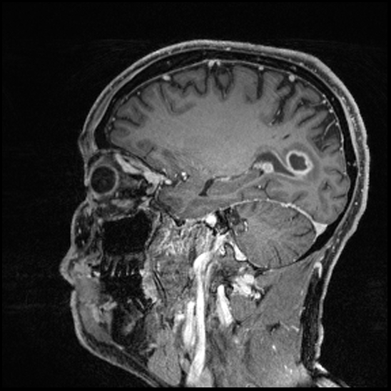 Cerebral abscess with ventriculitis (Radiopaedia 78965-91878 Sagittal T1 C+ 62).jpg