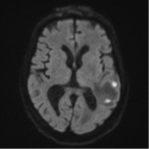 Cerebral abscesses- medically managed (Radiopaedia 45183-49179 Axial DWI 43).png