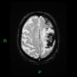 File:Cerebral amyloid angiopathy-associated lobar intracerebral hemorrhage (Radiopaedia 58376-65512 Axial Gradient Echo 6).jpg