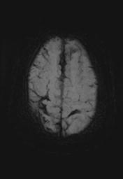 File:Cerebral amyloid angiopathy (Radiopaedia 29129-29518 Axial SWI MIP 25).jpg