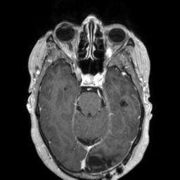 File:Cerebral amyloid angiopathy (Radiopaedia 29129-29518 Axial T1 C+ 54).jpg