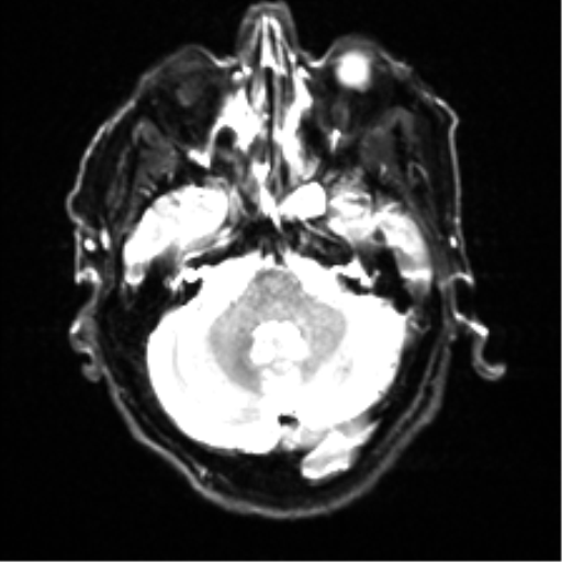 File:Cerebral amyloid angiopathy (Radiopaedia 46082-50433 Axial DWI 6).png