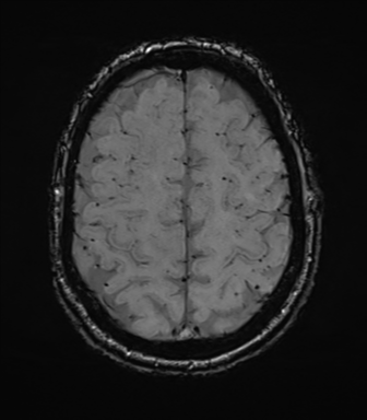 File:Cerebral amyloid angiopathy (Radiopaedia 46082-50433 Axial SWI 66).png