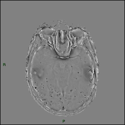 File:Cerebral amyloid angiopathy (Radiopaedia 77506-89664 H 43).jpg