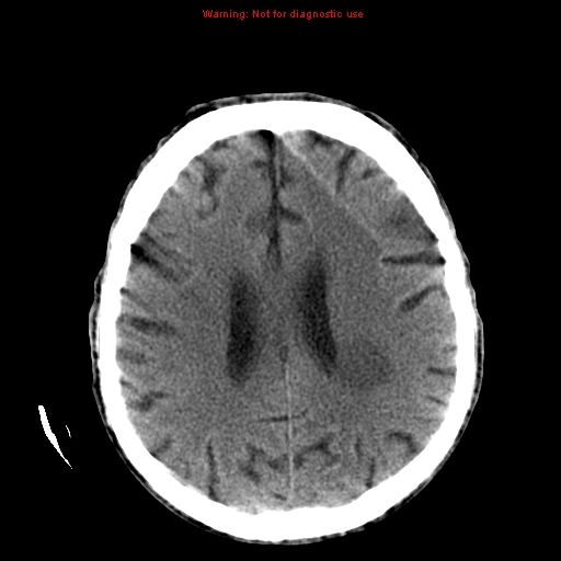 File:Cerebral and orbital tuberculomas (Radiopaedia 13308-13310 Axial non-contrast 19).jpg