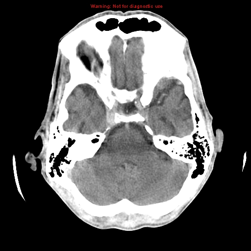 File:Cerebral and orbital tuberculomas (Radiopaedia 13308-13310 B 9).jpg