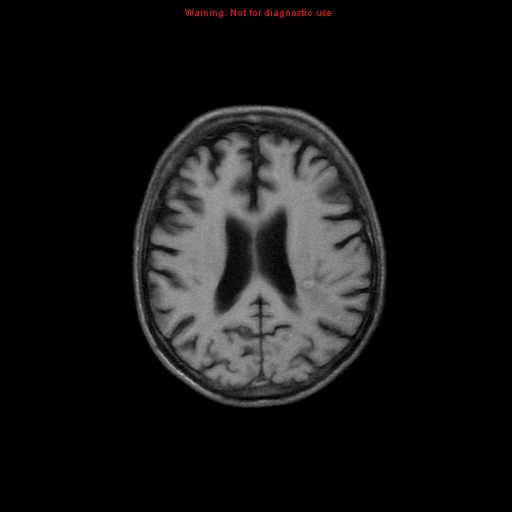File:Cerebral and orbital tuberculomas (Radiopaedia 13308-13311 Axial T1 14).jpg