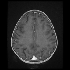 Cerebral and spinal tuberculosis (Radiopaedia 90489-107837 Axial T1 C+ 136).jpg