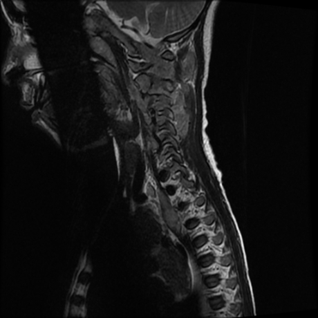 File:Cerebral and spinal tuberculosis (Radiopaedia 90489-107838 Sagittal 10).jpg