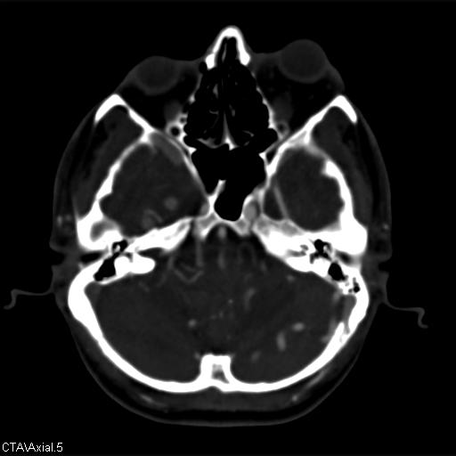 Cerebral arteriovenous malformation (Radiopaedia 28518-28759 B 5).jpg
