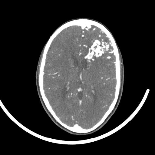 Cerebral arteriovenous malformation (Radiopaedia 29531-30031 E 30).jpg