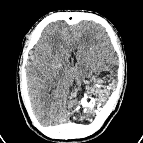Cerebral arteriovenous malformation (Radiopaedia 37182-39012 Axial non-contrast 24).jpg