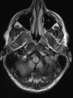 File:Cerebral arteriovenous malformation (Radiopaedia 55798-62372 Axial FLAIR 2).png