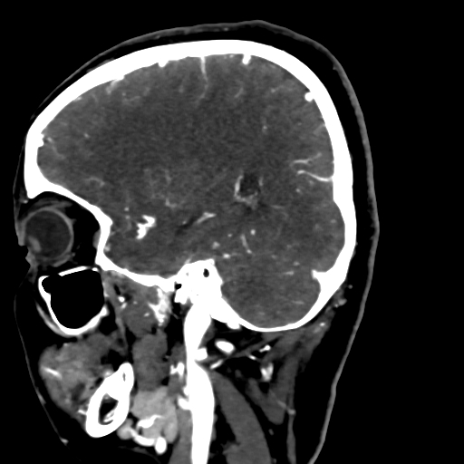 Cerebral arteriovenous malformation (Radiopaedia 73830-84645 Sagittal C+ delayed 28).jpg