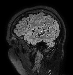 Cerebral arteriovenous malformation (Radiopaedia 74411-85654 Sagittal FLAIR 20).jpg