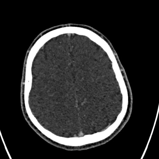 Cerebral arteriovenous malformation (Radiopaedia 78188-90746 Axial C+ delayed 131).jpg