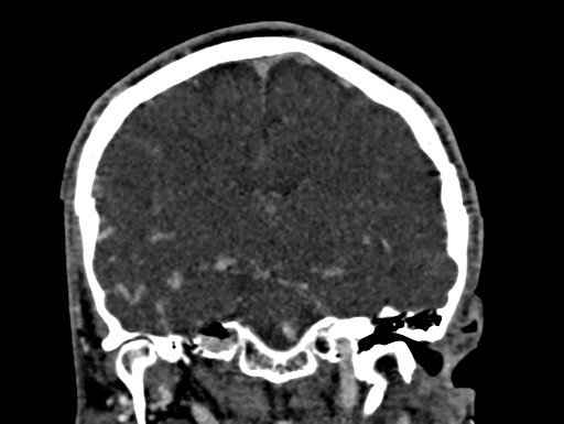 Cerebral arteriovenous malformation (Radiopaedia 78188-90746 Coronal C+ delayed 60).jpg